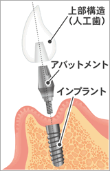 インプラント